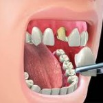 Dental Crown
