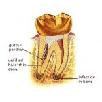 Root Canal Therapy