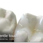 White Fillings