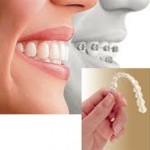 Invisible Braces