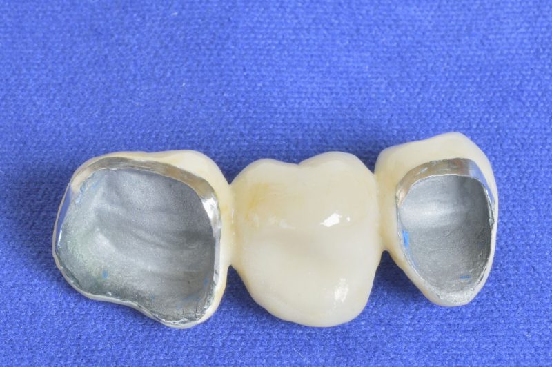 The Benefits of Dental Restoration in Marion, IA