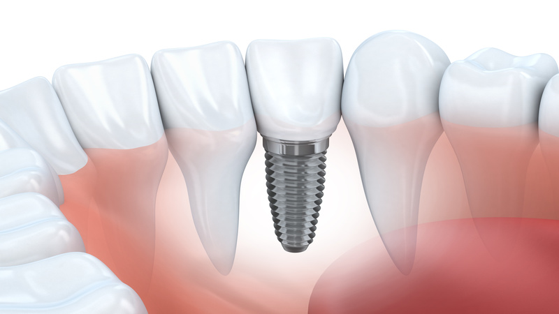 Implant Dentistry Services in Vancouver, WA Are Trending