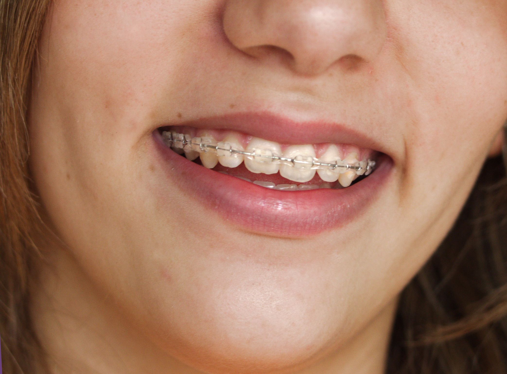 Signs You Need Orthodontics in Cape Coral Florida