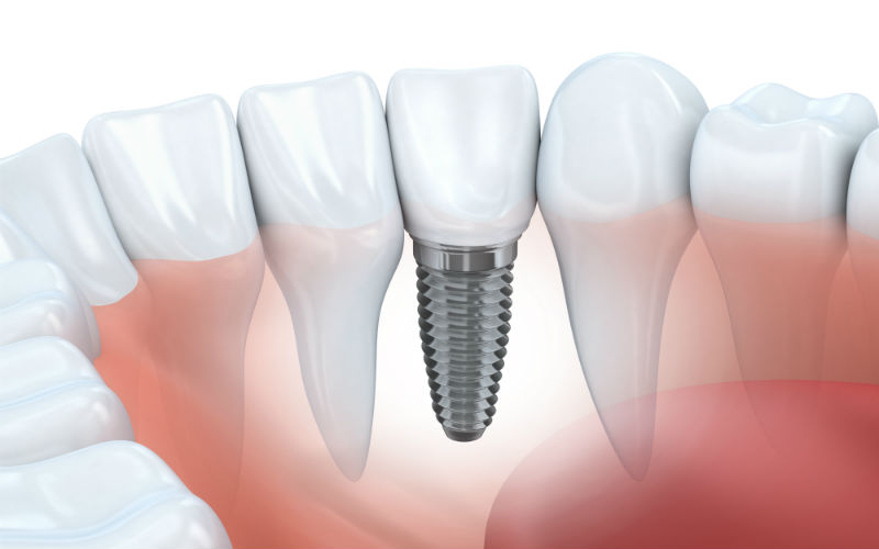 What You Should Know About Dental Implants in Charleston, SC