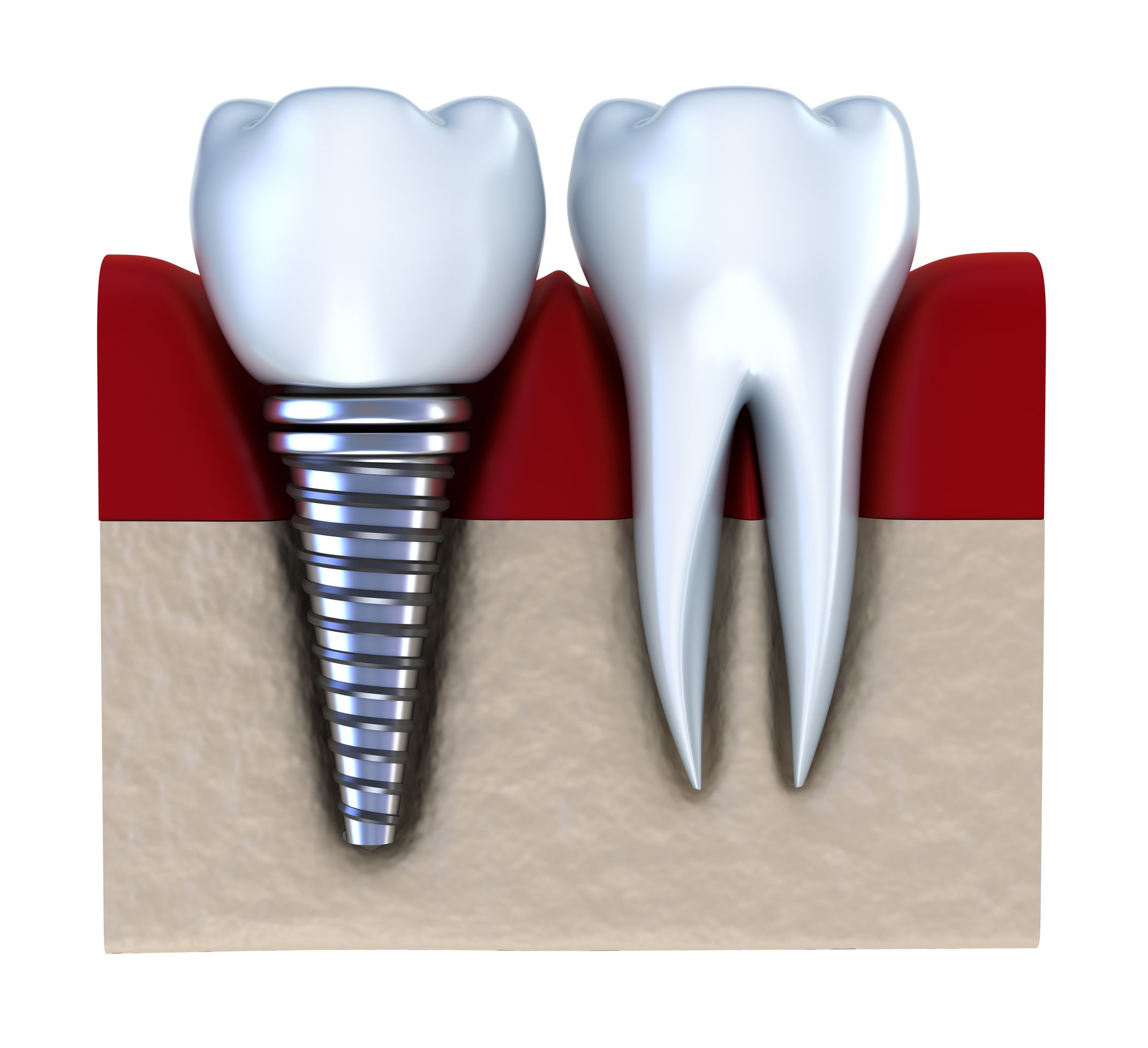 Teeth Implants – The Process and Recovery